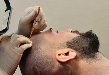 زراعة الشعر في تركيا واحدة من أهم أنواع السياحة العلاجية