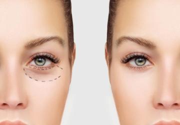 عملية شد الجفون في تركيا