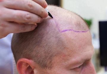 أصبحت إسطنبول وجهة فريدة للأشخاص الذين يبحثون عن التميز في زراعة الشعر