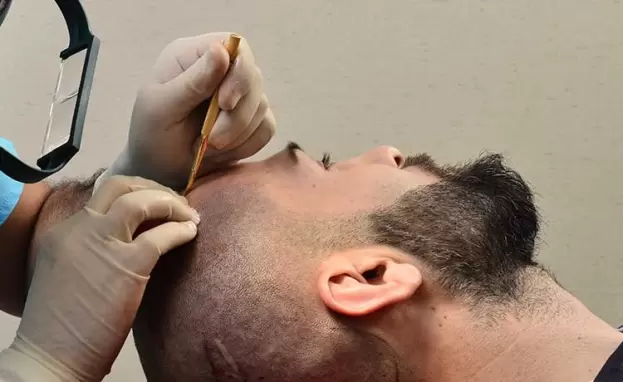زراعة الشعر في تركيا واحدة من أهم أنواع السياحة العلاجية