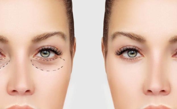 عملية شد الجفون في تركيا