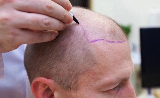 أصبحت إسطنبول وجهة فريدة للأشخاص الذين يبحثون عن التميز في زراعة الشعر